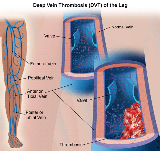 deep vein thrombosis treatment symptoms