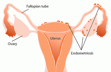 endometriosis e1486434764879
