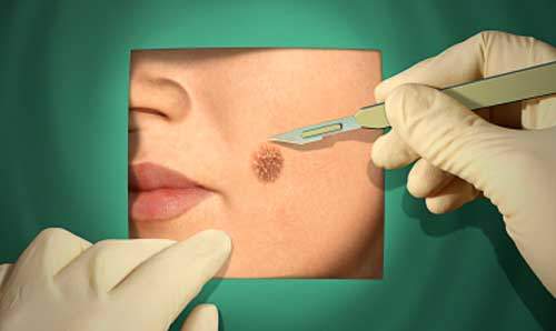 mole removal