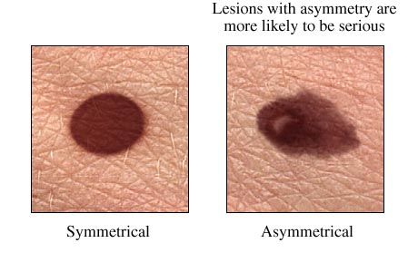 moles