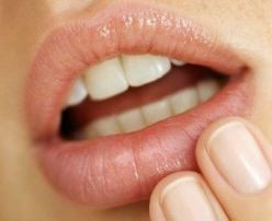 oral herpes e1486680904632