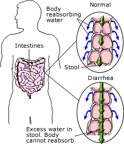Relieving Diarrhea with Natural Remedies Relieving Diarrhea with Natural Remedies